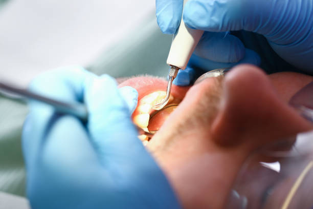 Best Emergency Tooth Extraction in Akron, NY