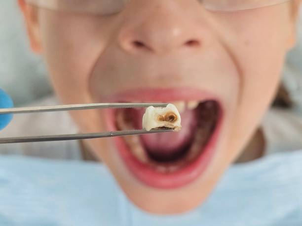 Best Emergency Treatment for Toothache in Akron, NY